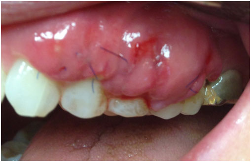 Gingival Hyperplasia After Root Coverage Procedure Conexis Dental